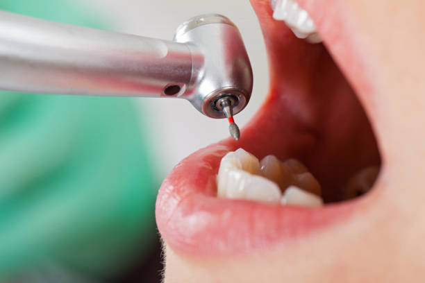 Best Emergency Wisdom Tooth Extraction in Logan, WV